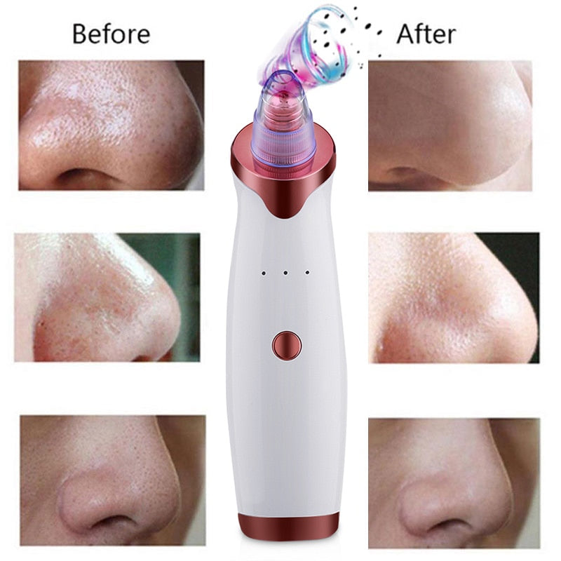 Black Spot/Pore Remover - Vacuum Skin Cleaner