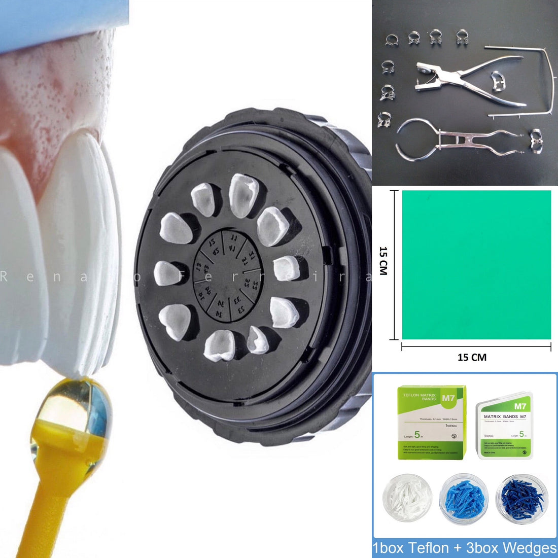 Cementation Kit - Veneers - Onlays