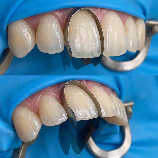 Interproximal Sectional Anterior Matrices