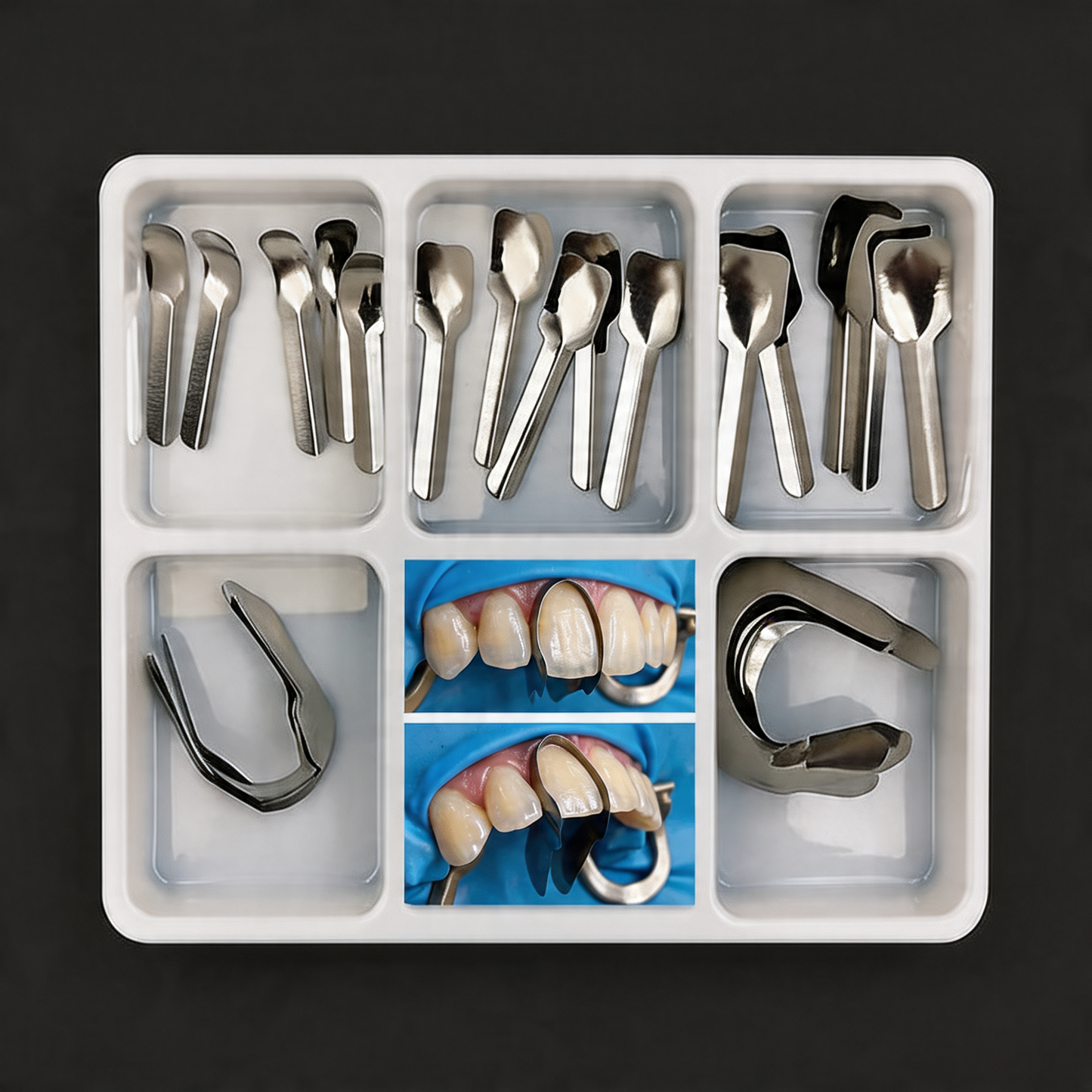 Interproximal Sectional Anterior Matrices