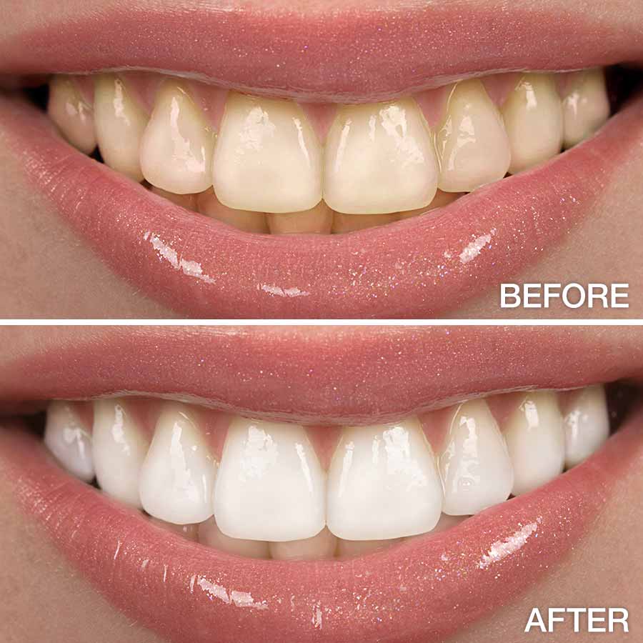 Carbamide Peroxide Teeth Whitening Gel 0.1%,6%,16%,22%,35%,44%CP  / Free Shipping