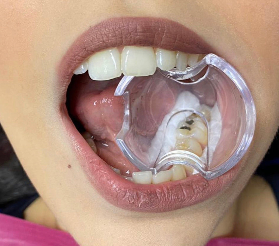 Autoclavable Retractor / Bite Block For Anterior/Posterior Teeth