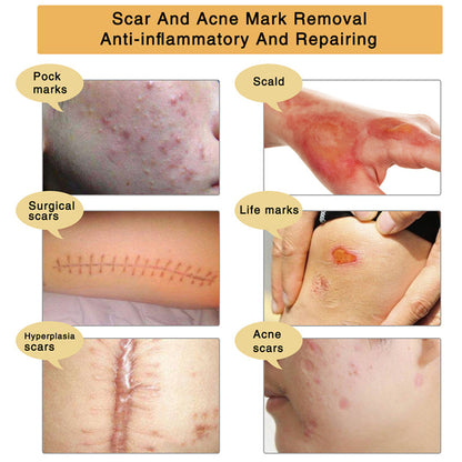 Acne Scar Removal Gel