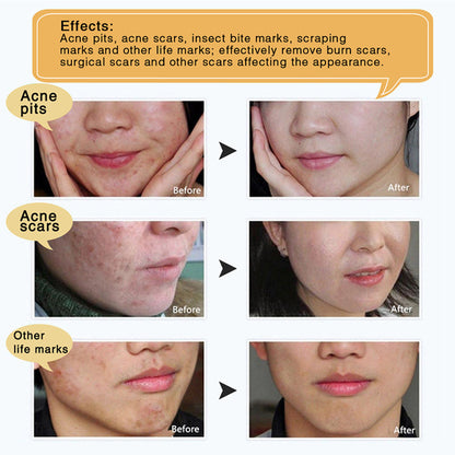 Acne Scar Removal Gel