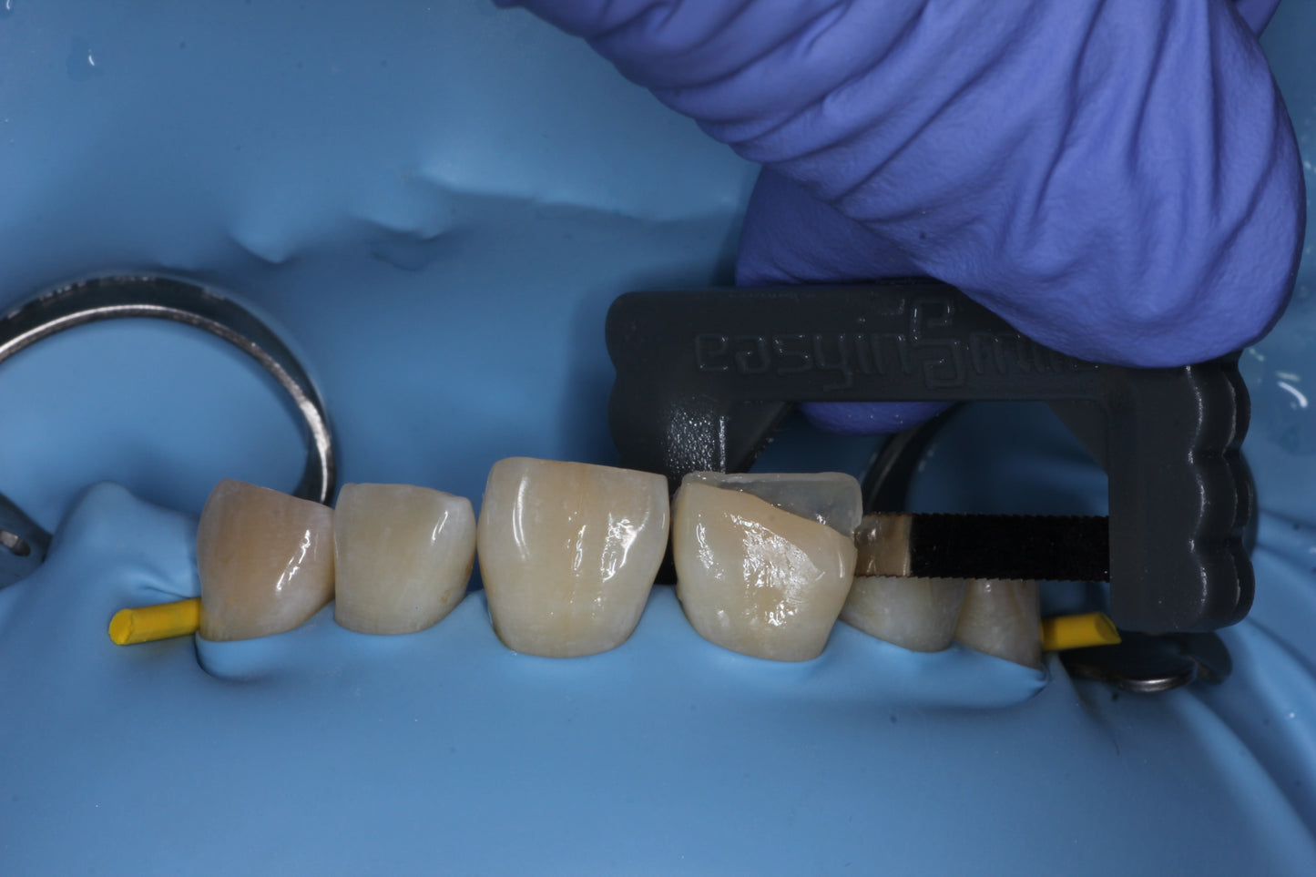 Restorative Interproximal Strip System -IPR