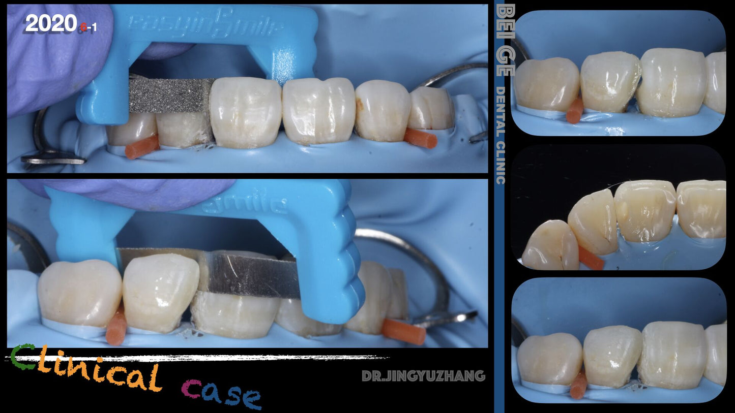 Restorative Interproximal Strip System -IPR