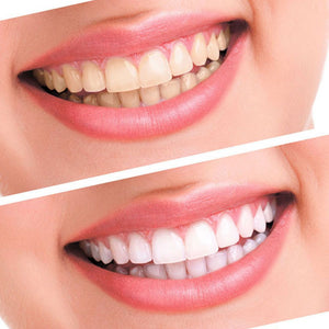 HeySmile Teeth Whitening Set *** FREE Global Shipping ***